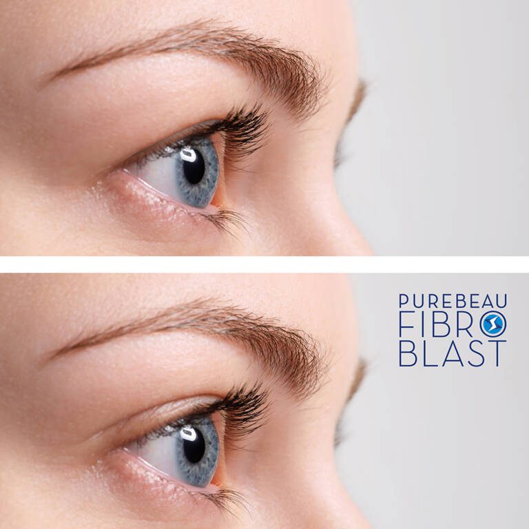 ricare-dettingen-fibroblast-vorher-nachher