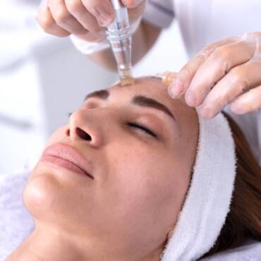 ricare-dettingen-microneedling