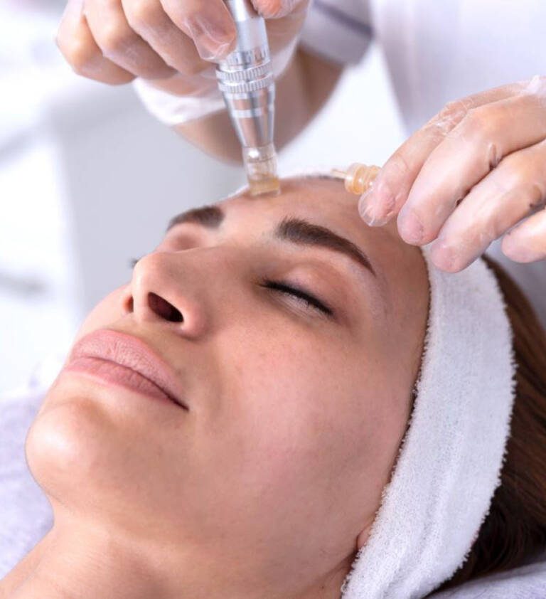 ricare-dettingen-microneedling-start